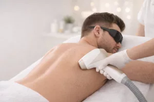 Ser haarentfernung ruecken mann skinforma